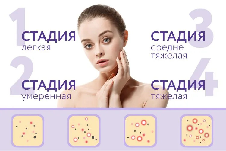 Стадии акне