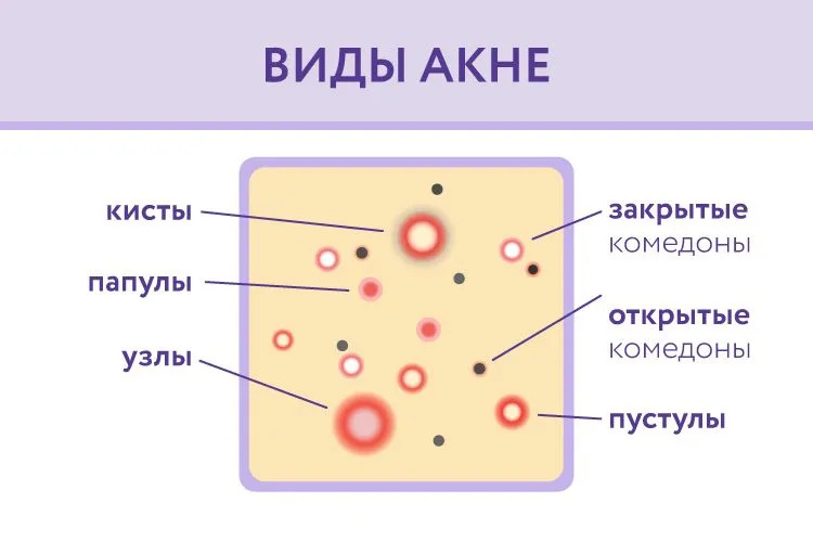 Виды акне