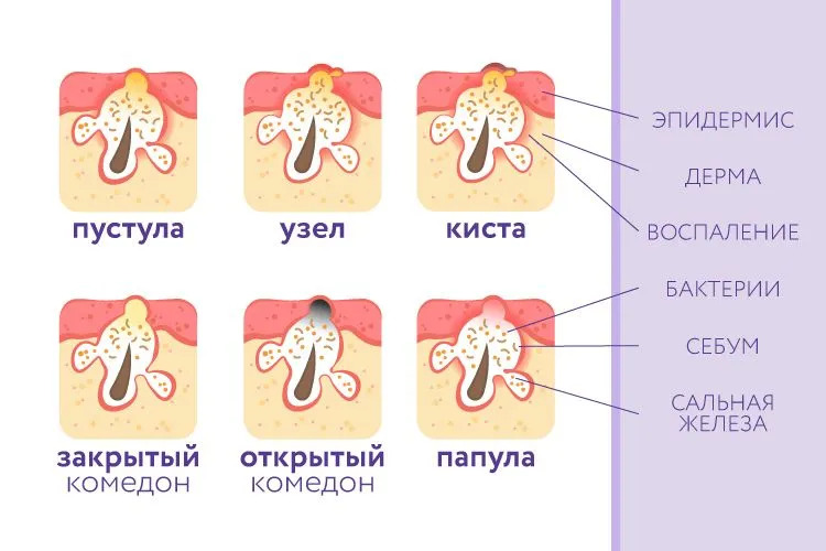 Виды акне