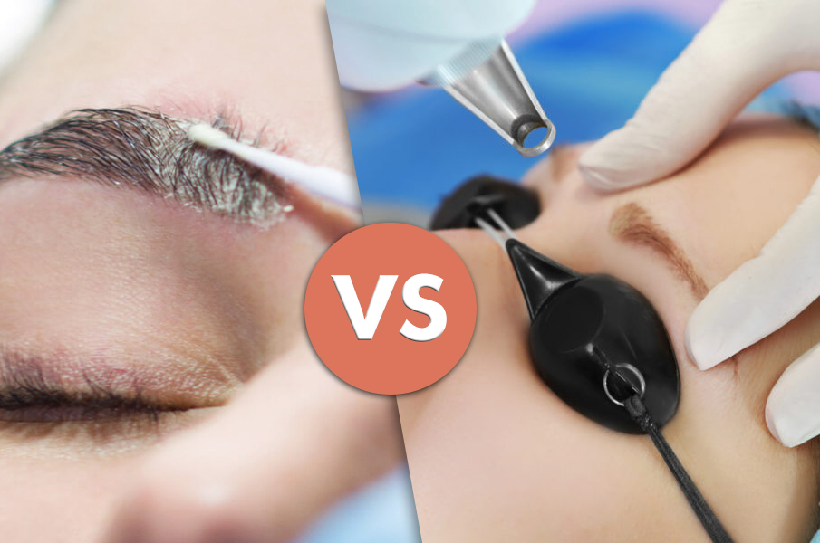 remover-vs-laser