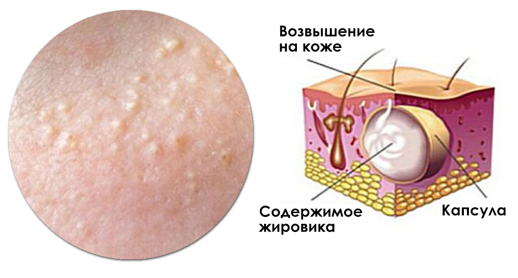 Жировик
